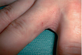 Hautveränderung zwischen den Fingern