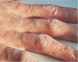 Hauterkrankung Hand